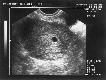 ecografia 5 settimane gravidanza