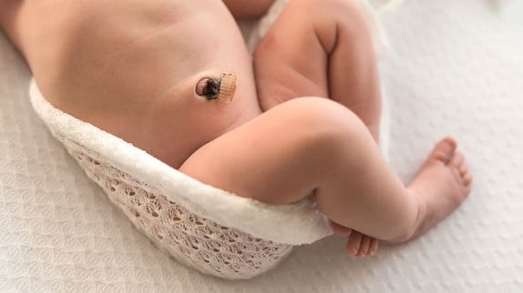 Infezione cordone ombelicale e onfalite neonato