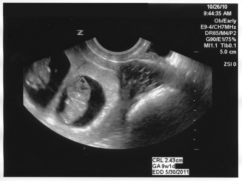 ecografia 9 settimana di gravidanza