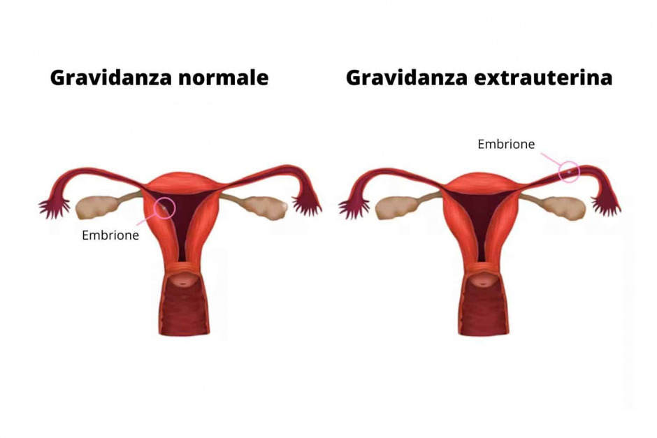 gravidanza extrauterina (1)