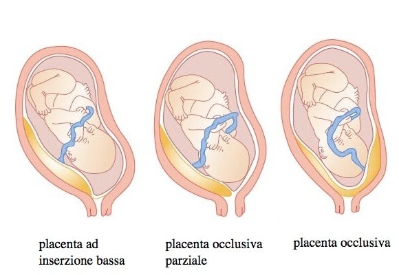 La placenta previa