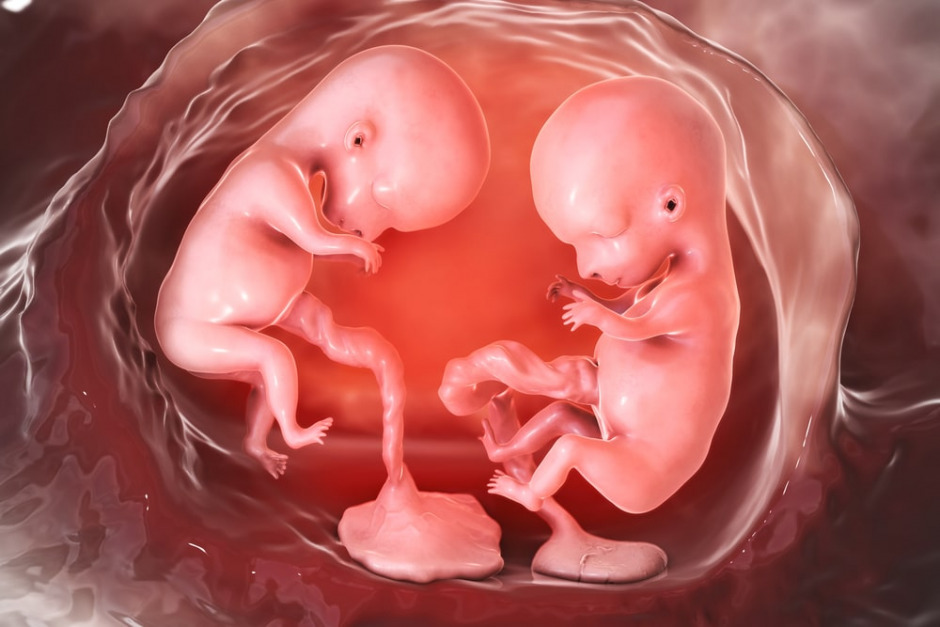 due gemelli monozigoti con placente separate alla quattordicesima settimana di gravidanza