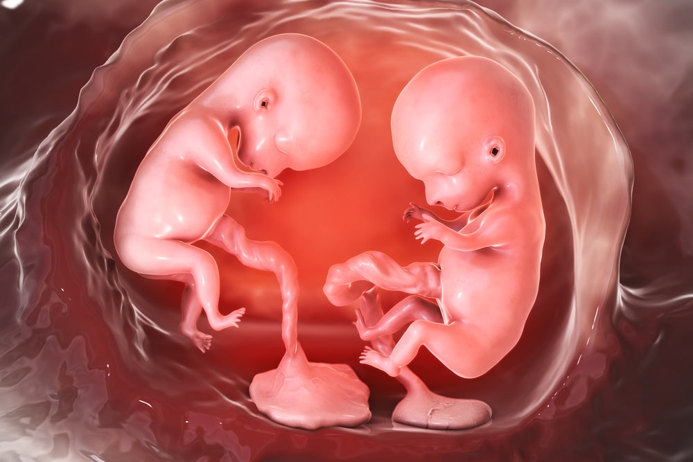 due gemelli monozigoti con placente separate alla quattordicesima settimana di gravidanza