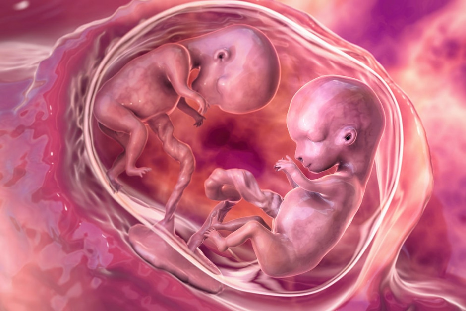 due gemelli monozigoti con placente separate alla quindicesima settimana di gravidanza